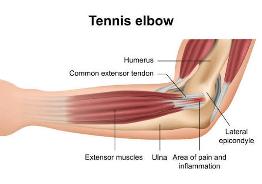 Best Doctors For Tennis Elbow in South Mumbai
